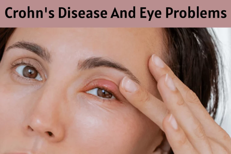 Crohn’s Disease Eyes
