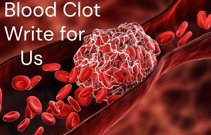 Blood Clot Write for Us