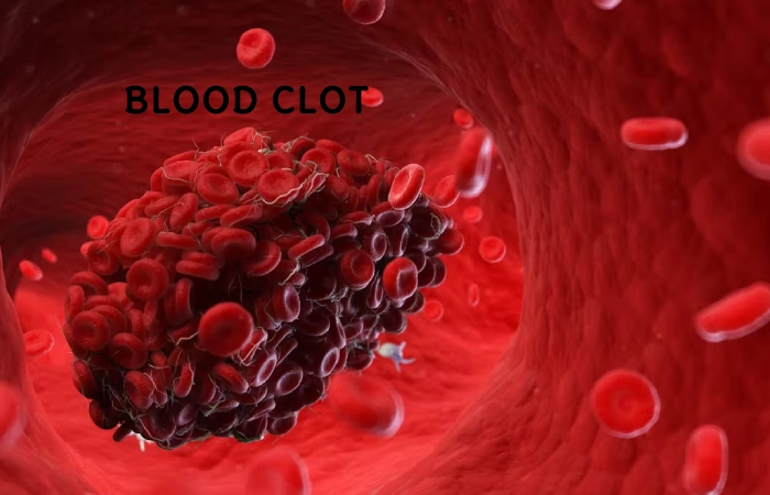 Blood Clots