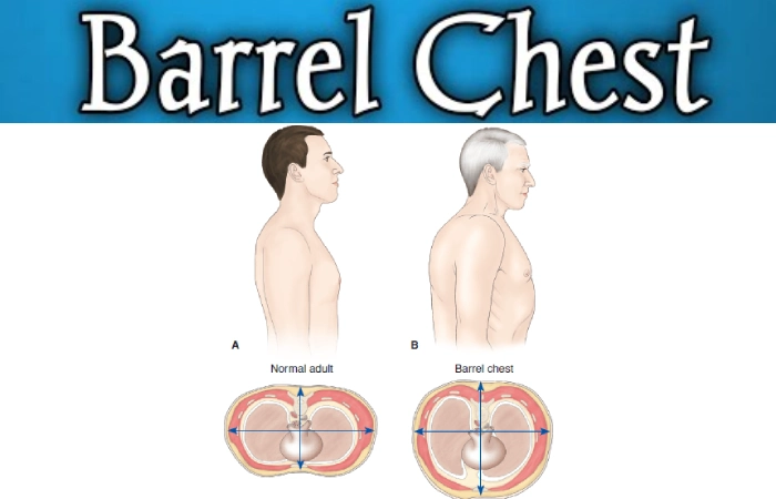 Barrel Chest