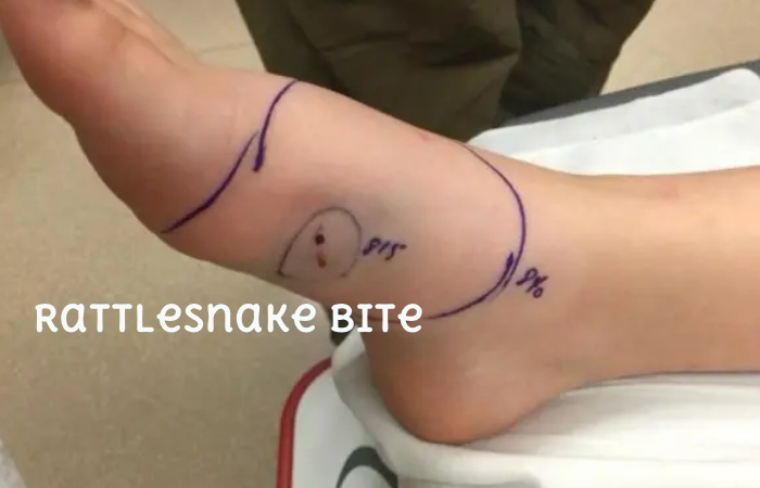 Rattlesnake Bite