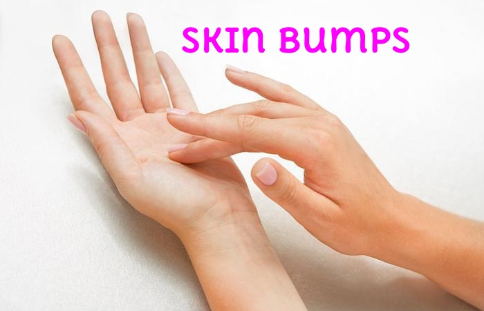 Skin Bumps