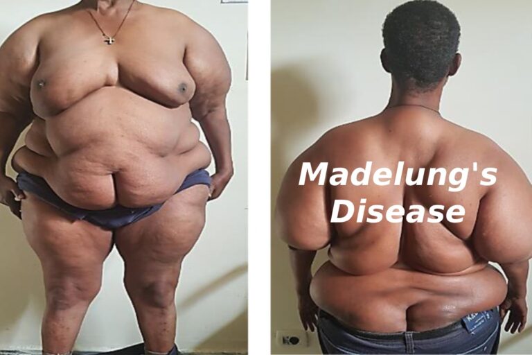 madelung's disease